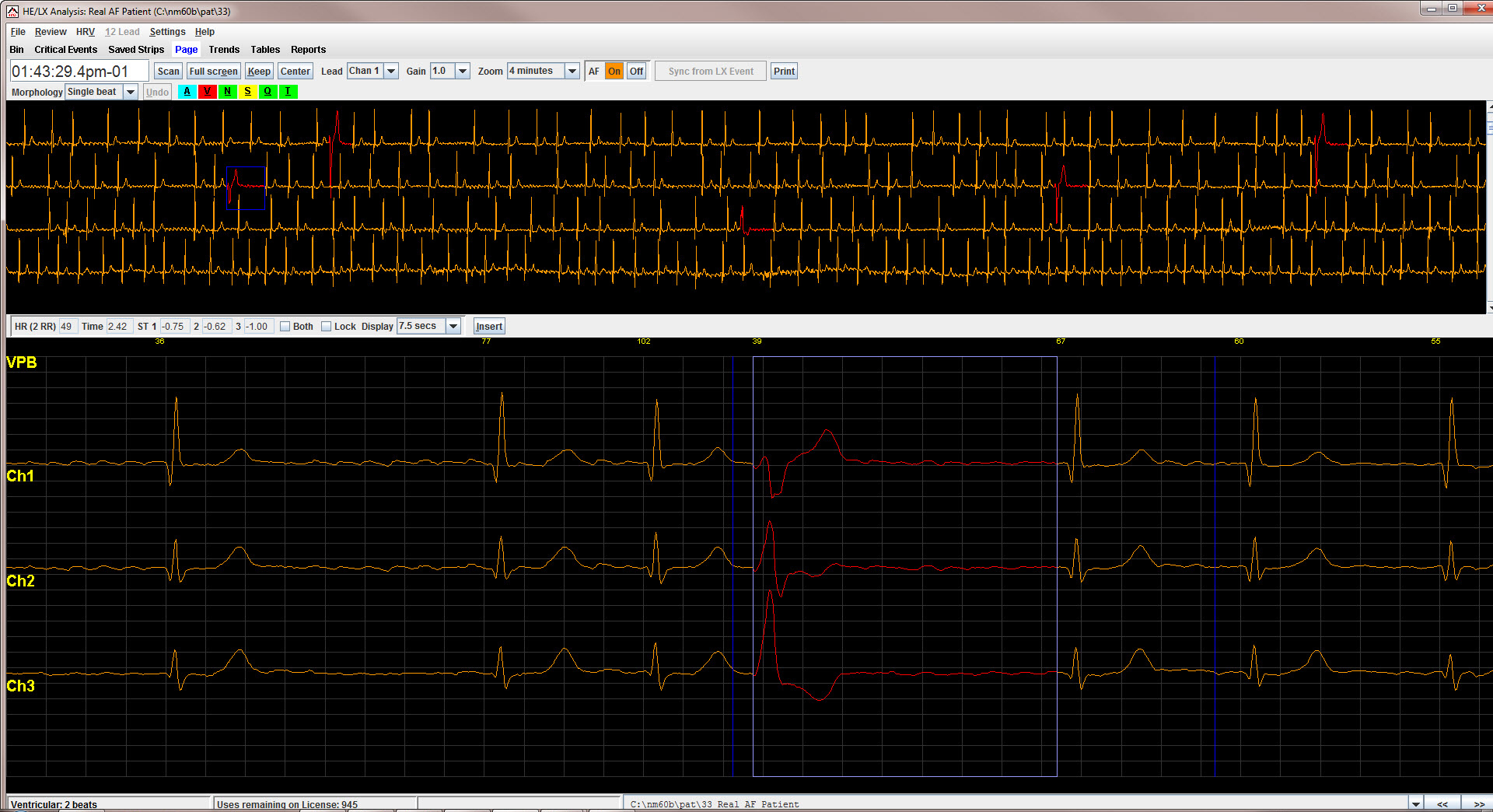 Holter LX Analysis PRO Software