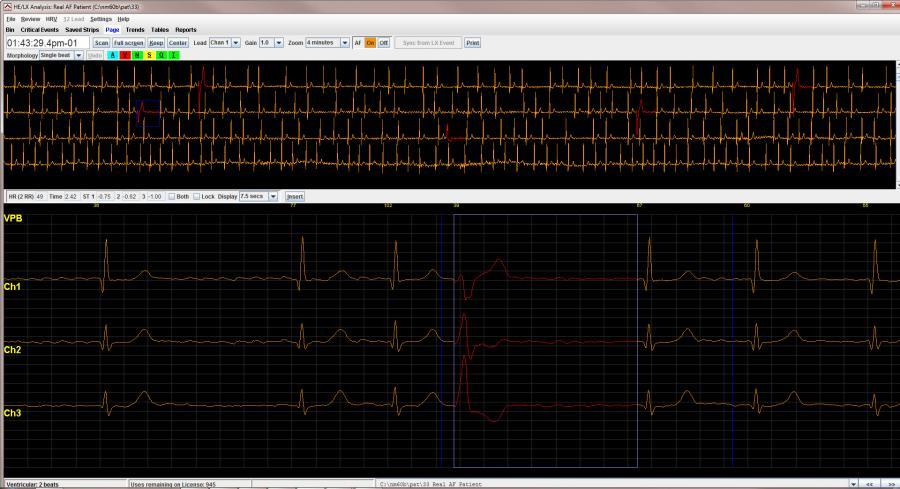 Holter LX Analysis (HE/LX) Software