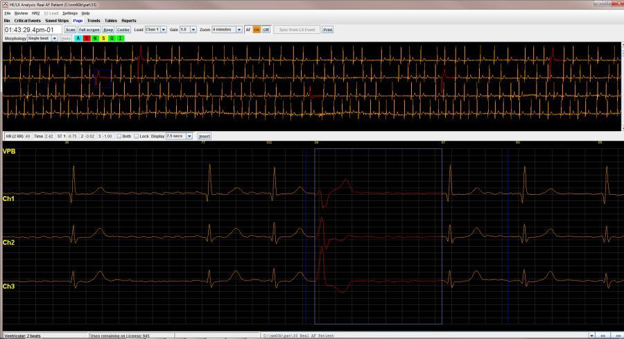 Holter LX Analysis PRO Software